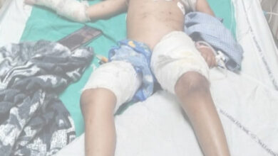 6 वर्ष के बच्चे पर कुत्तों के झुंड ने किया जानलेवा हमला, 100 जगह नोचा