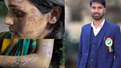 गर्म पानी में चेहरा डूबाकर पति ने की जान से मारने की कोशिश, सास-ससुर भी शामिल गर्म पानी में चेहरा डूबाकर पति ने की जान से मारने की कोशिश, सास-ससुर भी शामिल