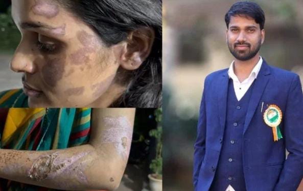 गर्म पानी में चेहरा डूबाकर पति ने की जान से मारने की कोशिश, सास-ससुर भी शामिल गर्म पानी में चेहरा डूबाकर पति ने की जान से मारने की कोशिश, सास-ससुर भी शामिल
