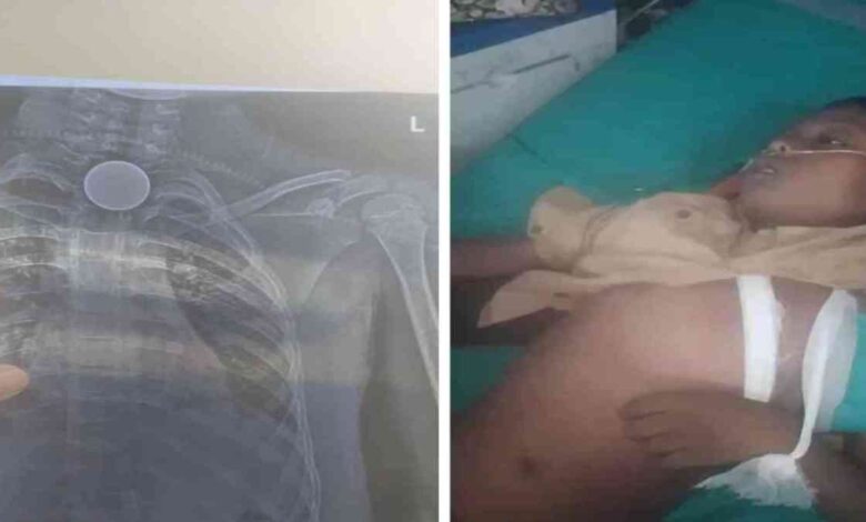 कोरबा में दर्दनाक हादसा: 8 वर्षीय बच्चे की सिक्का निगलने से मौत कोरबा में दर्दनाक हादसा: 8 वर्षीय बच्चे की सिक्का निगलने से मौत