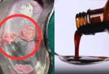 सीरप की बोतल में संदिग्ध वस्तु मिलने का मामला, जांच के लिए नमूने भेजे गए राज्य औषधि परीक्षण प्रयोगशाला