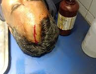 निर्माणाधीन श्याम एथेनॉल एंड स्पिरिट्स में सुरक्षा कर्मियों पर हमला, चार घायल, एक गंभीर