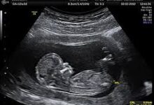 उच्च जोखिम वाली 1667 गर्भवती महिलाओं का किया गया नि:शुल्क सोनोग्राफी