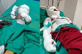 औद्योगिक दुर्घटना में झुलसे तीन लोगों की हुई मौत