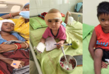 जन्मजात बधिरता से जूझ रहे तीन बच्चों का एम्स रायपुर में सफल कॉक्लियर इंप्लांट