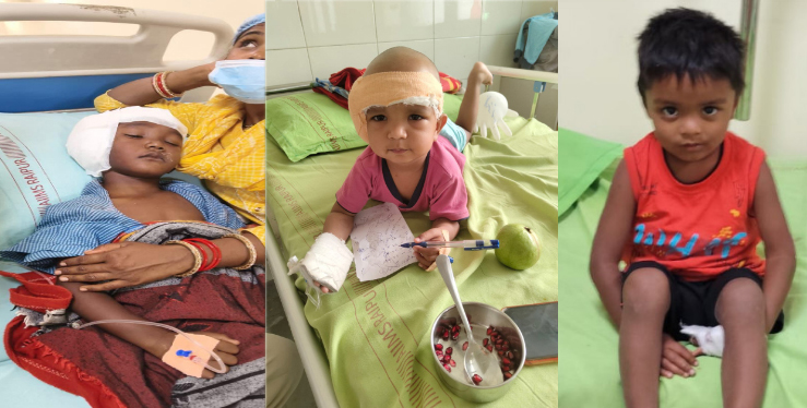 जन्मजात बधिरता से जूझ रहे तीन बच्चों का एम्स रायपुर में सफल कॉक्लियर इंप्लांट