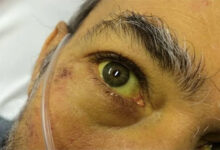 मोमिनपुरा में 47 व्यक्तियों की जांच में केवल एक में मिला पीलिया का लक्षण