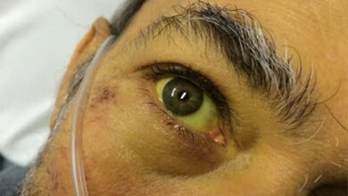 मोमिनपुरा में 47 व्यक्तियों की जांच में केवल एक में मिला पीलिया का लक्षण