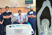 चाकू से कटी मुख्य धमनी, सबक्लेवियन आर्टरी को जोड़कर मेकाहारा के डॉक्टरों ने बचाया युवक का हाथ
