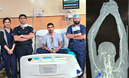 चाकू से कटी मुख्य धमनी, सबक्लेवियन आर्टरी को जोड़कर मेकाहारा के डॉक्टरों ने बचाया युवक का हाथ