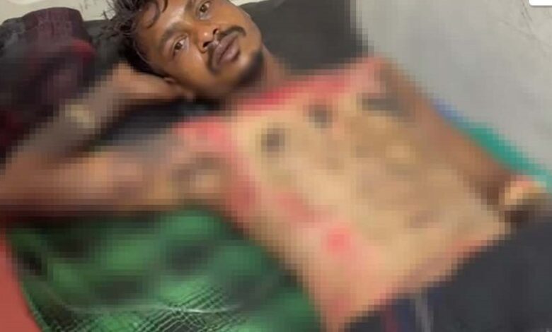 जांजगीर-चांपा युवक को जिंदा जलाकर मारने की कोशिश, तालाब में कूदकर बचाई जान