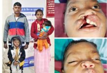 शासन की चिरायु दल के पहल पर जन्मजात फटे होंठ व तालु से विक्रम को मिली निजात