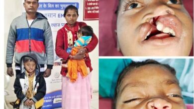 शासन की चिरायु दल के पहल पर जन्मजात फटे होंठ व तालु से विक्रम को मिली निजात