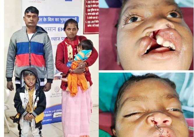 शासन की चिरायु दल के पहल पर जन्मजात फटे होंठ व तालु से विक्रम को मिली निजात