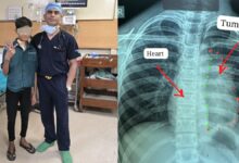 11 साल के बच्चे के दिल से निकाला दुर्लभ कैंसर, डॉक्टरों ने रचा इतिहास