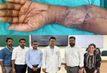 एम्स रायपुर के डॉक्टरों ने 70 वर्षीय बुजुर्ग का कटा हुआ हाथ सफलतापूर्वक जोड़ा