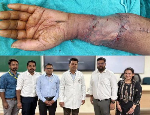 एम्स रायपुर के डॉक्टरों ने 70 वर्षीय बुजुर्ग का कटा हुआ हाथ सफलतापूर्वक जोड़ा