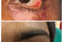 स्किन ग्राफ्टिंग से मरीज के पलक का सफल पुनर्निर्माण, नई दृष्टि और सामान्य जीवन की ओर लौटने का मिला अवसर