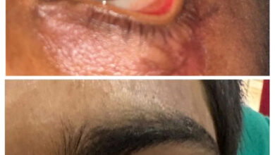 स्किन ग्राफ्टिंग से मरीज के पलक का सफल पुनर्निर्माण, नई दृष्टि और सामान्य जीवन की ओर लौटने का मिला अवसर