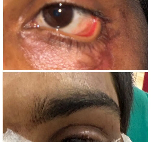 स्किन ग्राफ्टिंग से मरीज के पलक का सफल पुनर्निर्माण, नई दृष्टि और सामान्य जीवन की ओर लौटने का मिला अवसर