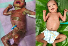 सुदूर बीजापुर में चिकित्सा चमत्कार, अत्यंत दुर्लभ बीमारी से जूझते शिशु को बचाया, केले के पत्तों से किया गया विशेष देखभाल