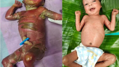 सुदूर बीजापुर में चिकित्सा चमत्कार, अत्यंत दुर्लभ बीमारी से जूझते शिशु को बचाया, केले के पत्तों से किया गया विशेष देखभाल