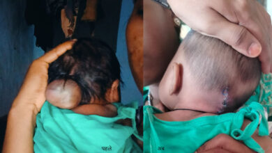 पांच माह की अनुष्का को मिला नया जीवन, चिरायु योजना से संभव हुई सफल सर्जरी