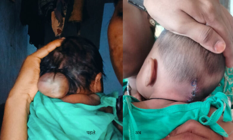 पांच माह की अनुष्का को मिला नया जीवन, चिरायु योजना से संभव हुई सफल सर्जरी पांच माह की अनुष्का को मिला नया जीवन, चिरायु योजना से संभव हुई सफल सर्जरी
